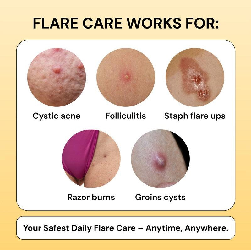 MyMegicHearal's Thyme & Tea Tree Flare Care | Cystic Acne and Bumps Treatment Skincare Daily Pimple