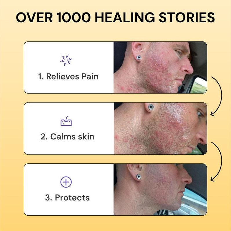 MyMegicHearal's Thyme & Tea Tree Flare Care | Cystic Acne and Bumps Treatment Skincare Daily Pimple
