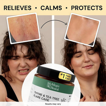 MyMegicHearal's Thyme & Tea Tree Flare Care | Cystic Acne and Bumps Treatment Skincare Daily Pimple